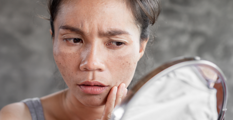 Woman examining facial acne in mirror